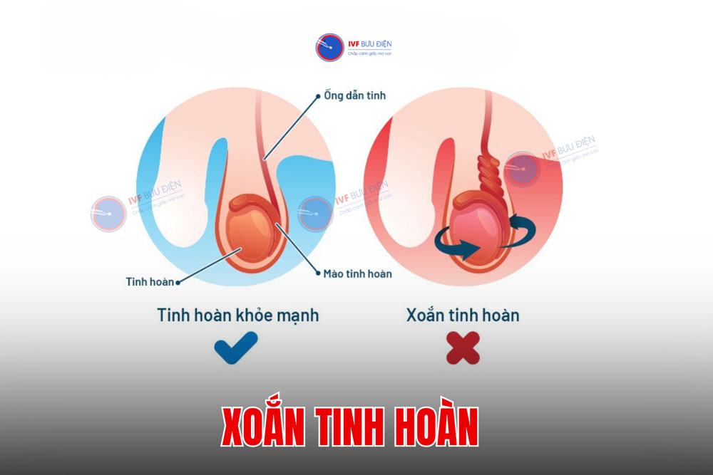 Xoắn tinh hoàn