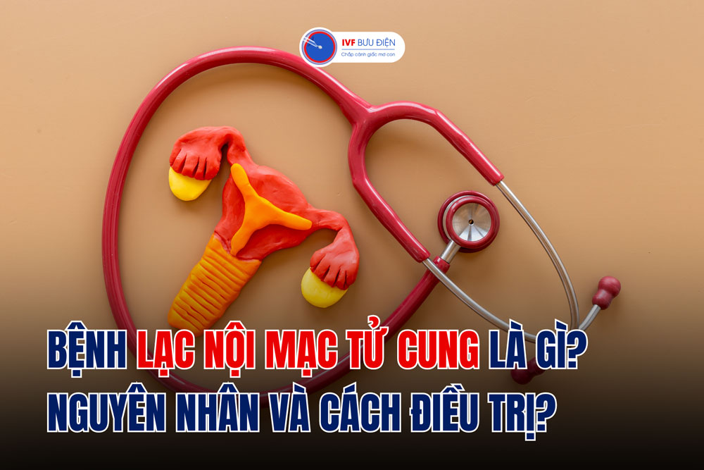 Bệnh lạc nội mạc tử cung là gì? Nguyên nhân và cách điều trị?