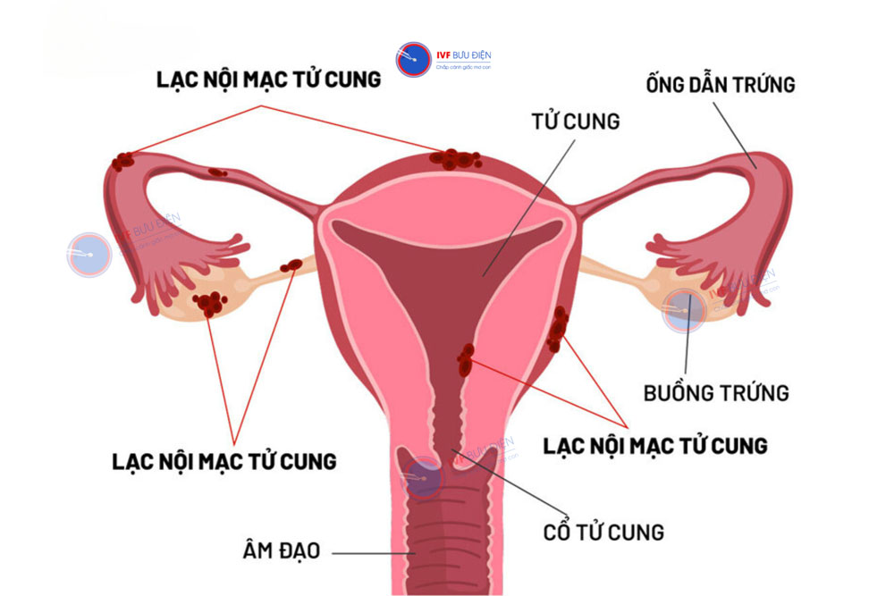 lạc nội mạc tử cung