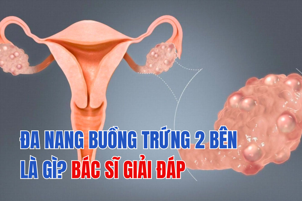 Bệnh đa nang buồng trứng 2 bên là gì? Bác sĩ giải đáp