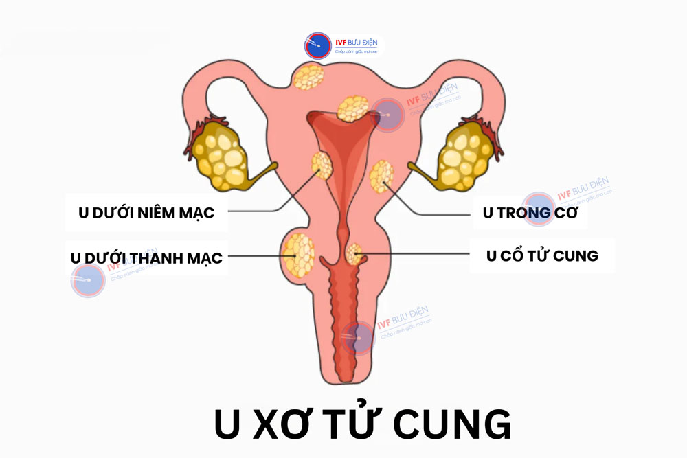 u xơ cổ tử cung