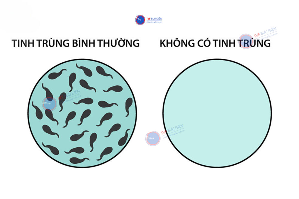 Vô tinh ở nam giới