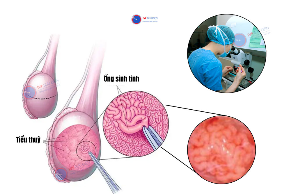 Phương pháp Micro- TESE