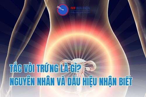 Tắc vòi trứng là gì? Nguyên nhân và dấu hiệu nhận biết