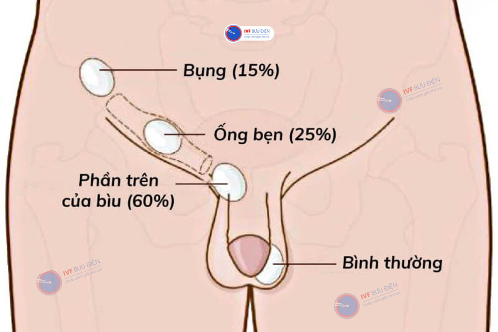 Các vị trí của tinh hoàn lạc chỗ