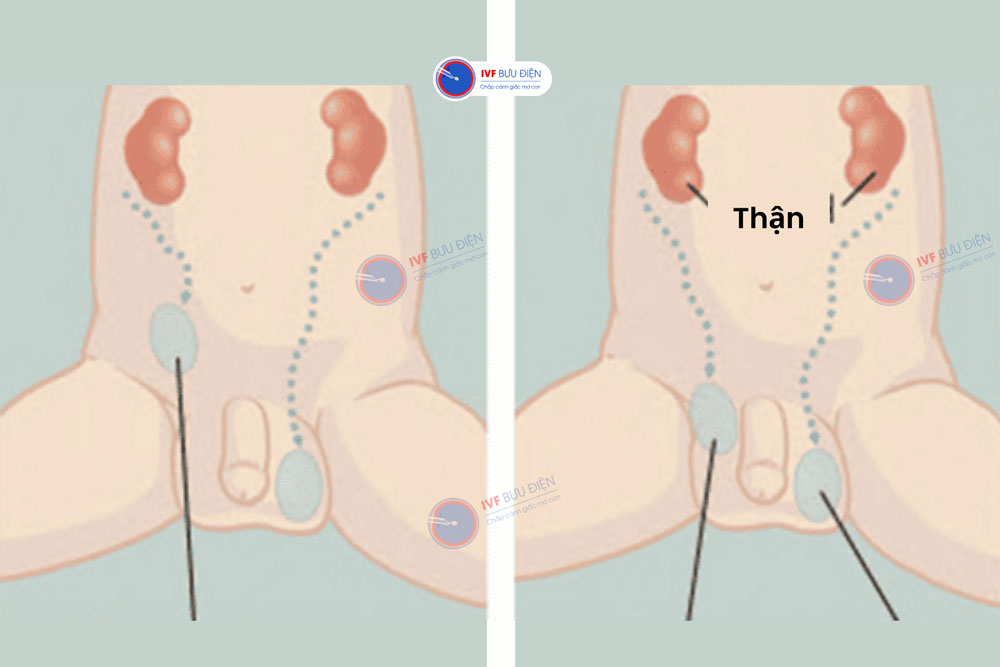 Chuyên gia y tế thực hiện phẫu thuật sẽ đưa tinh hoàn lạc chỗ về vị trí phù hợp