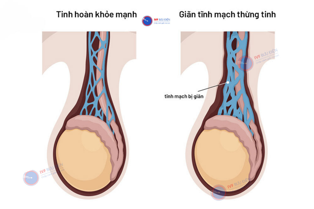 Giãn tĩnh mạch thừng tinh