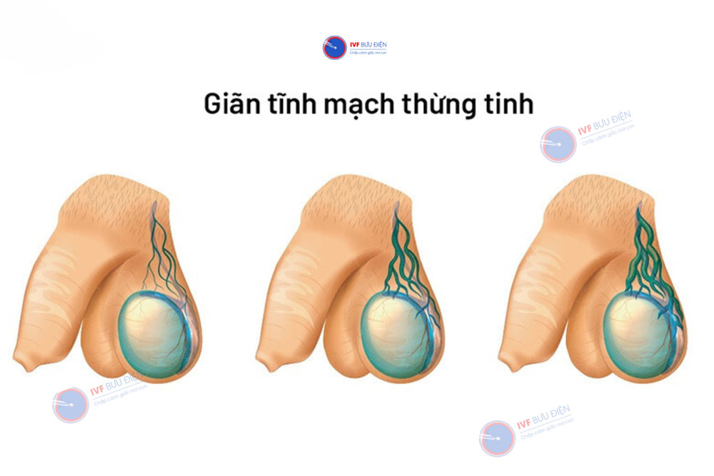 giãn tĩnh mạch thừng tinh 2 bên