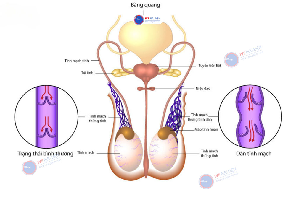 Các van tĩnh mạch kém hiệu quả khiến dòng chảy bị ảnh hưởng