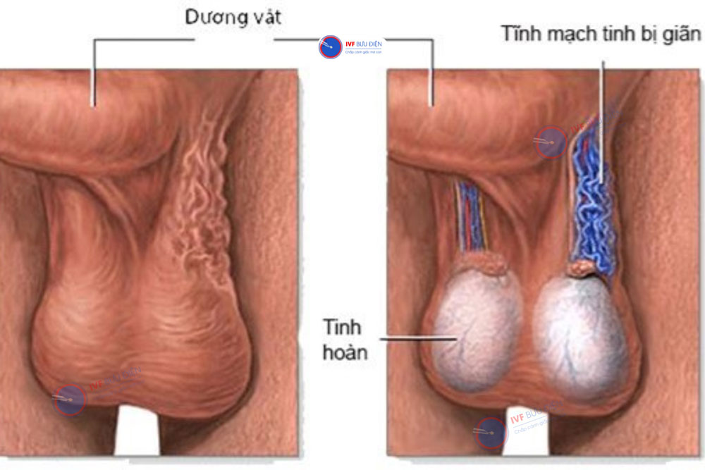 Người bệnh có thể cảm giác nặng ở vùng bìu