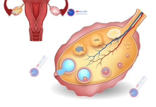 Thông qua hình ảnh siêu âm nang noãn, bác sĩ sẽ có những phương pháp hỗ trợ phù hợp