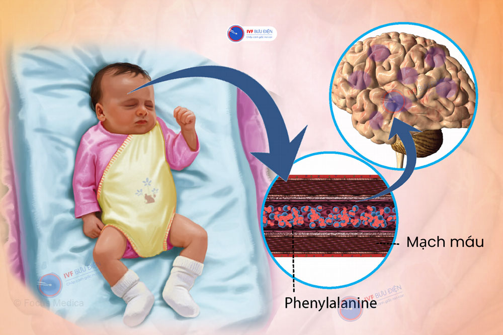Nguyên nhân bệnh Phenylketone niệu