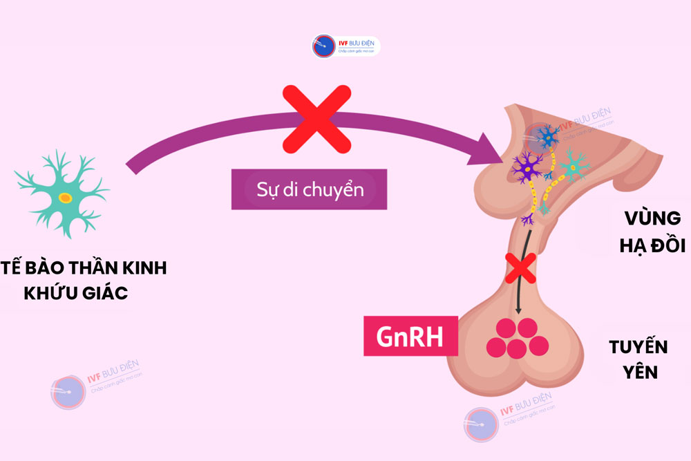 Các tế bào thần kinh không di chuyển đúng vị trí được cho là nguyên nhân gây bệnh