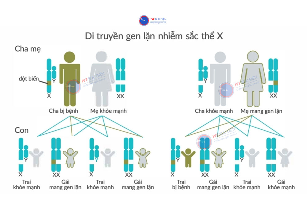 Cơ chế di truyền hội chứng Kallman