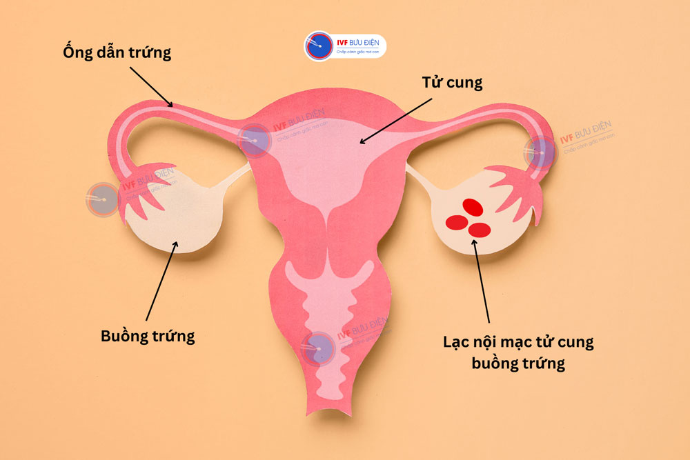 Lạc nội mạc tử cung buồng trứng