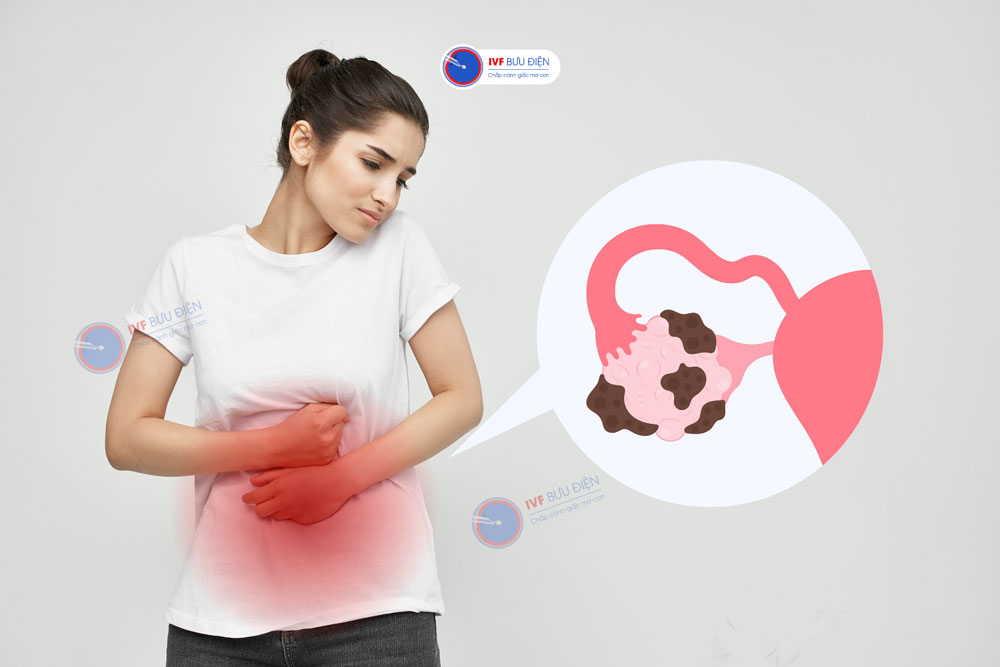 Đau vùng chậu mạn tính