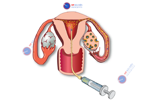 Thủ thuật bơm tinh trùng vào buồng tử cung IUI