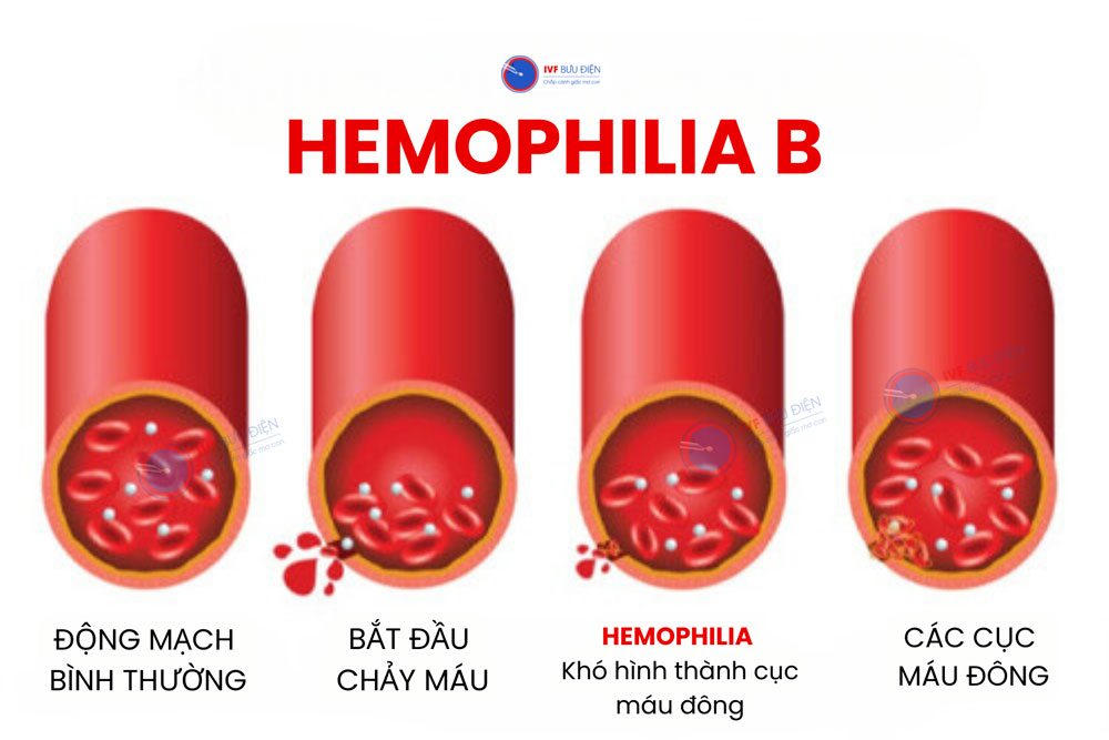 hemophilia B