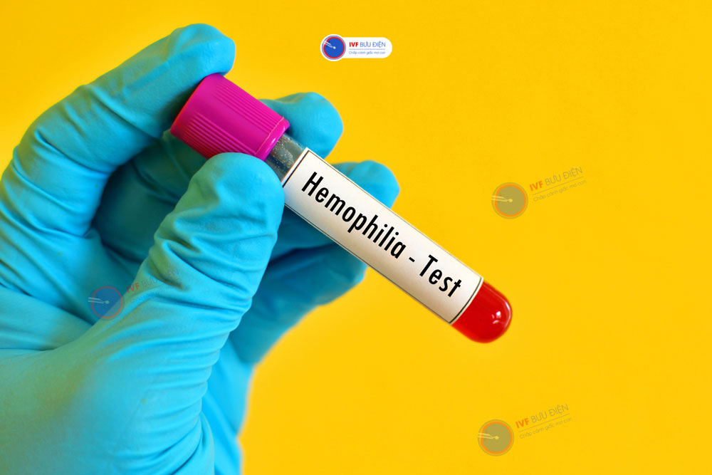 xét nghiệm hemophilia B
