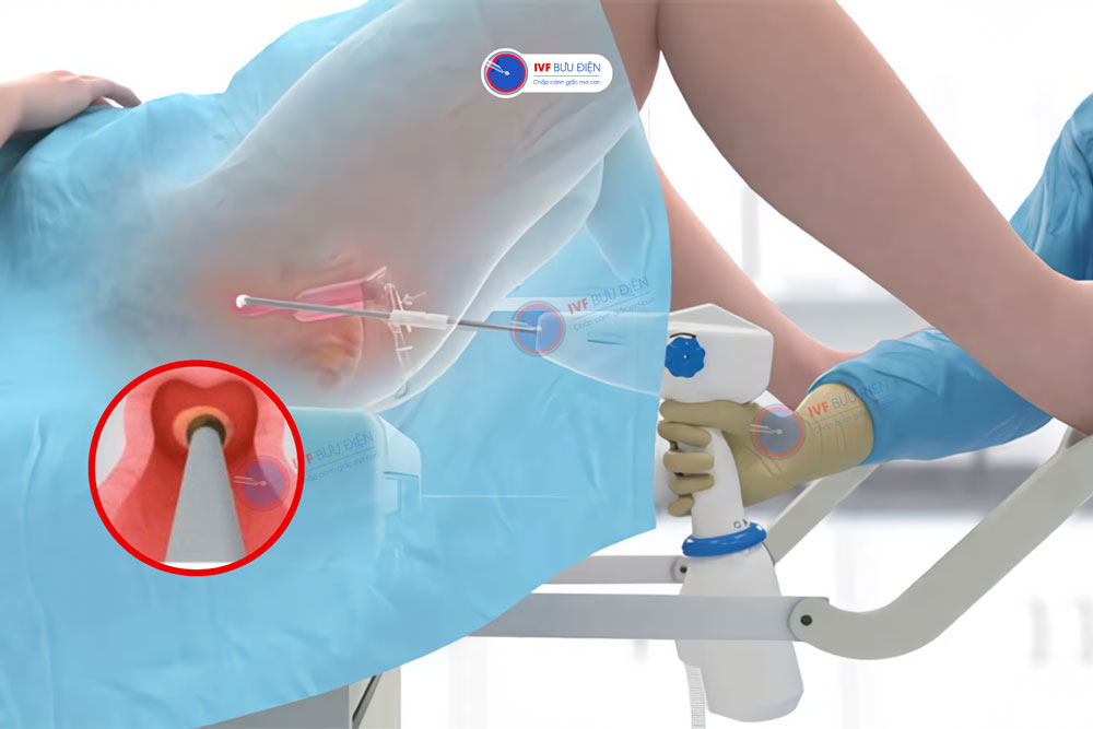 Áp lạnh là cách điều trị viêm lộ tuyến cổ tử cung