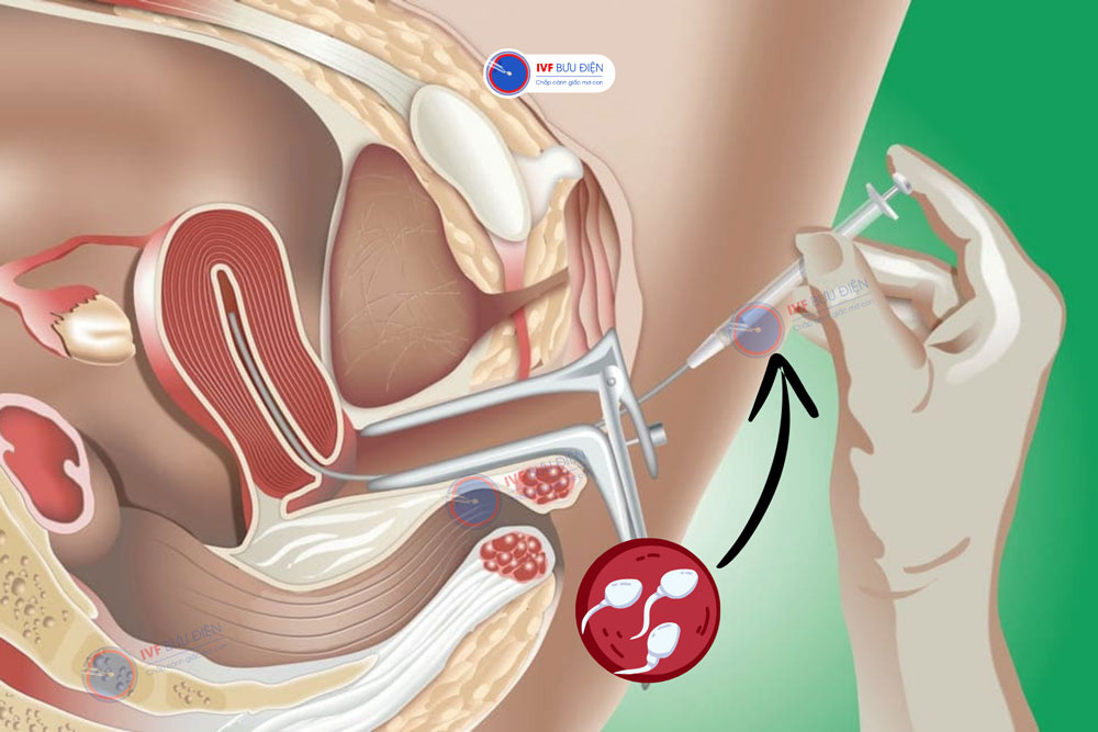 Bác sĩ sẽ bơm tinh trùng đã lọc rửa vào tử cung phụ nữ