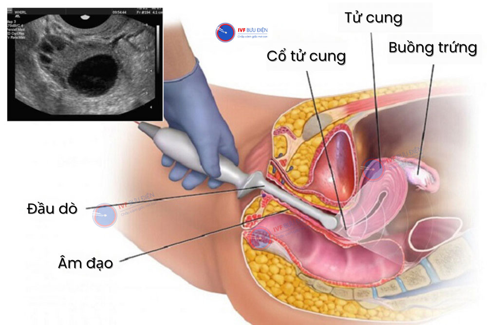 Siêu âm đầu dò là một trong những xét nghiệm có thể đánh giá sức khoẻ buồng trứng