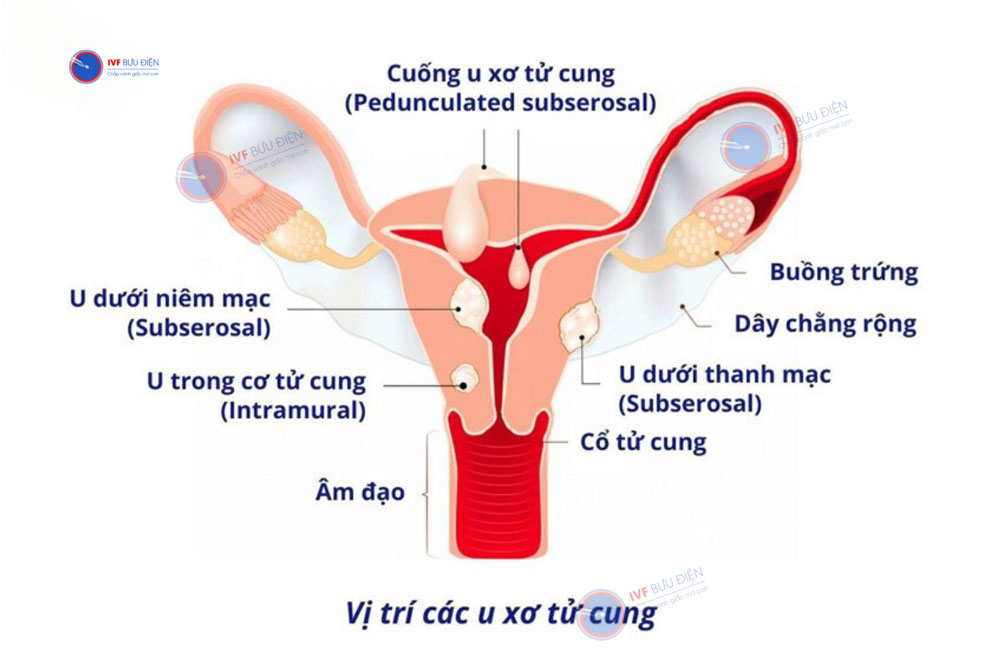 u xơ tử cung