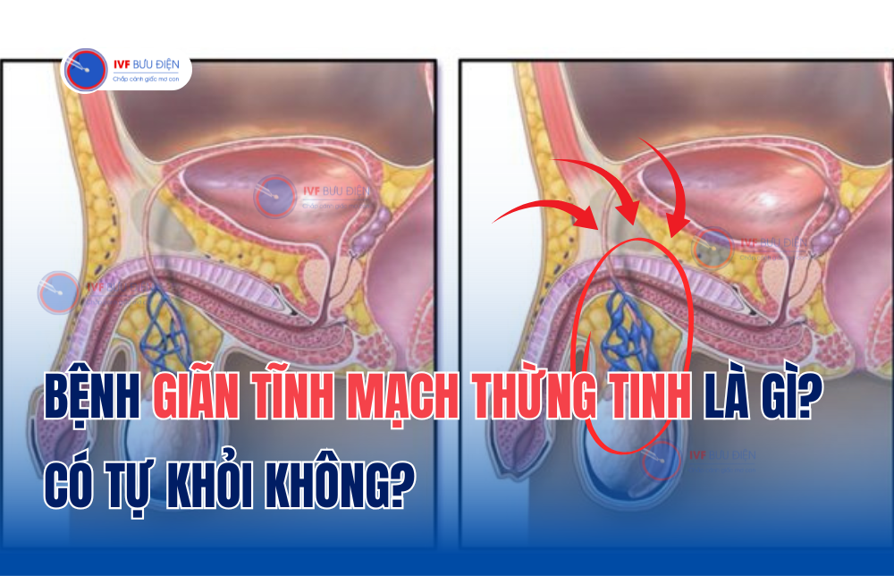 Bệnh giãn tĩnh mạch thừng tinh là gì? có tự khỏi không?