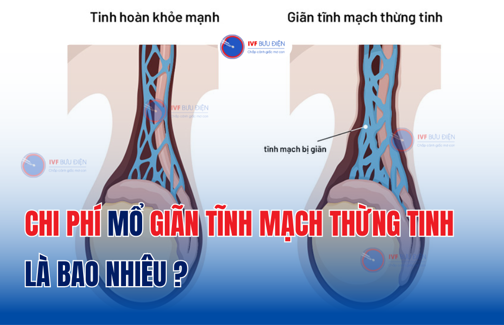 Chi phí mổ giãn tĩnh mạch thừng tinh là bao nhiêu vậy bác sĩ?