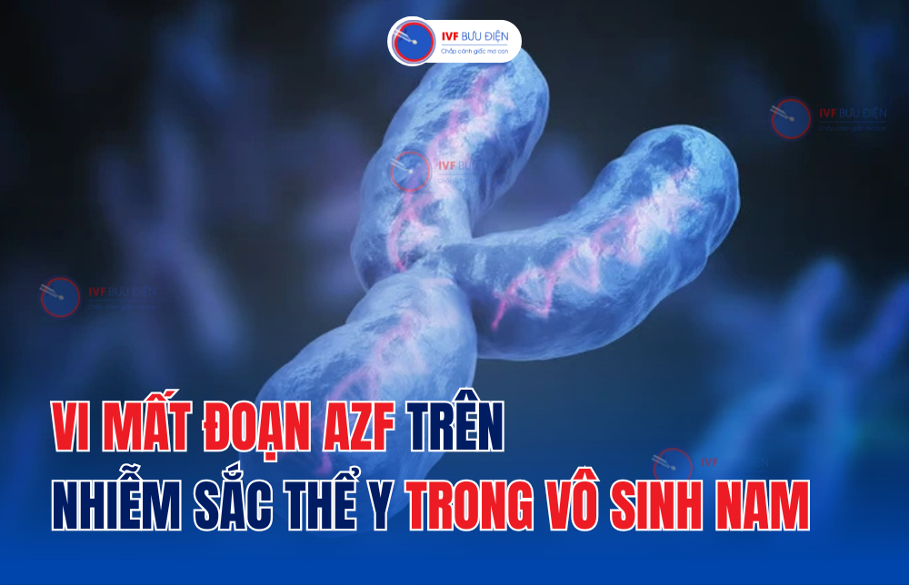 Vi mất đoạn AZF trên nhiễm sắc thể Y trong vô sinh nam