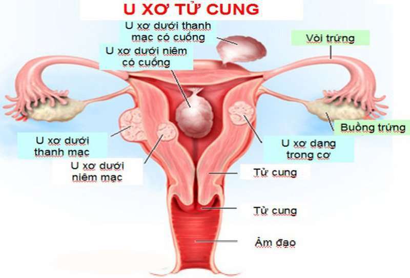 U xơ tử cung: Dấu hiệu nhận biết