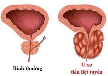 Hình ảnh U xơ tiền liệt tuyến