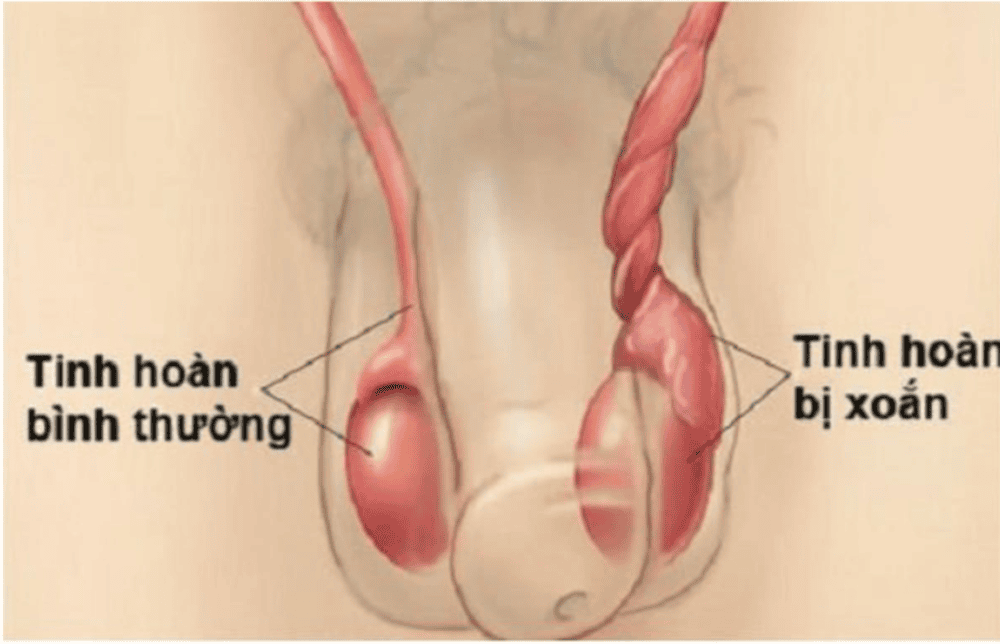 Xoắn tinh hoàn gây suy tinh hoàn