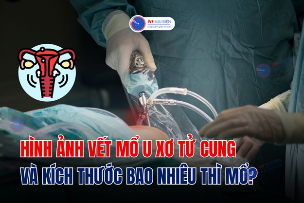 Hình ảnh vết mổ u xơ tử cung và kích thước bao nhiêu thì mổ?