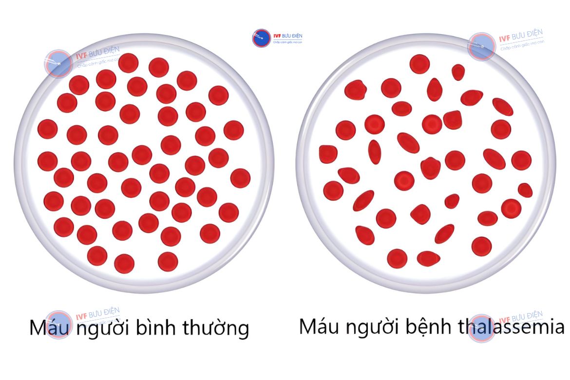 Bệnh Alpha thalassemia là gì