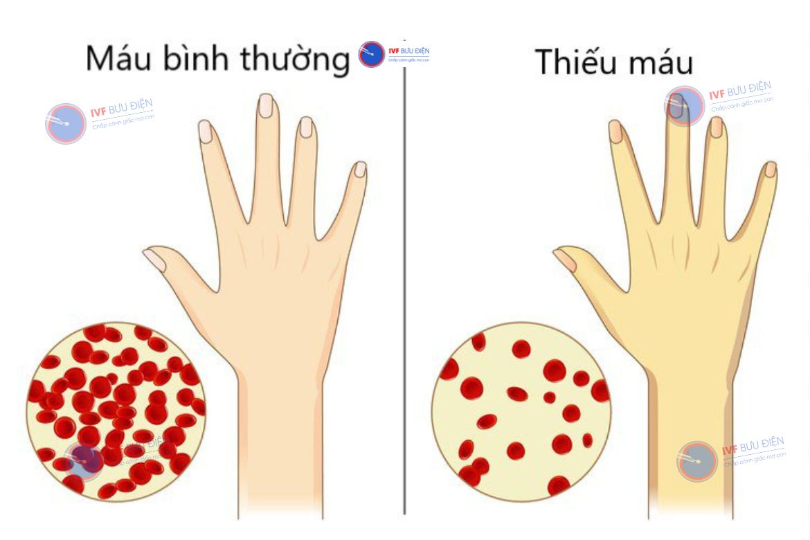 Thiếu máu là biến chứng phổ biến của bệnh Alpha thalassemia