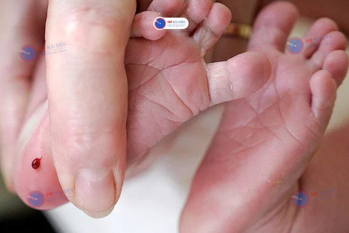 Lấy máu gót chân để chẩn đoán bệnh Alpha thalassemia ở trẻ sơ sinh