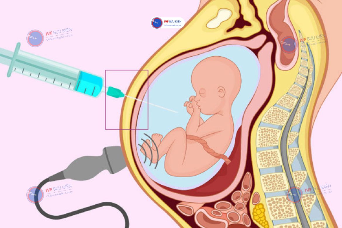 Chọc ối là phương pháp giúp chẩn đoán bệnh Alpha thalassemia cho trẻ từ trong bụng mẹ