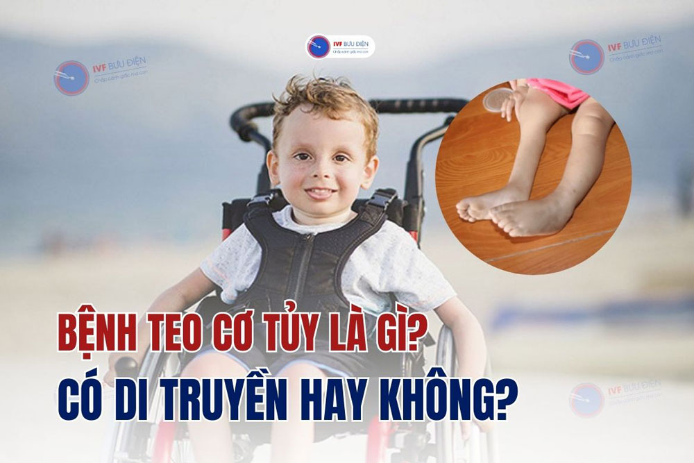 Bệnh teo cơ tủy là gì? Có di truyền hay không?
