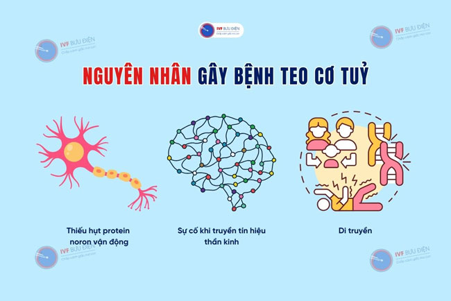 Nguyên nhân gây bệnh teo cơ tuỷ