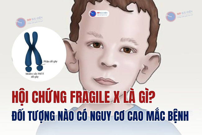 Hội chứng Fragile X là gì? Đối tượng nào có nguy cơ cao mắc bệnh