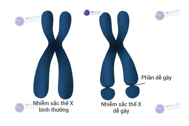 Hội chứng Fragile X là gì