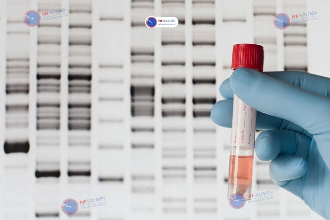 Xét nghiệm DNA là phương pháp giúp chẩn đoán chính xác hội chứng Fragile X