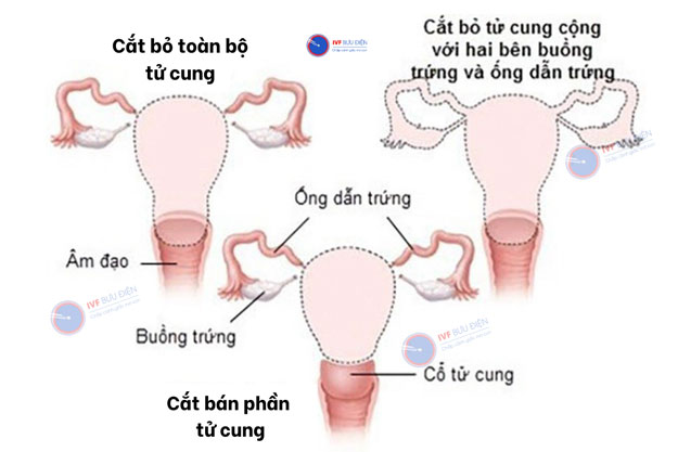 Các loại phẫu thuật u xơ tại tử cung