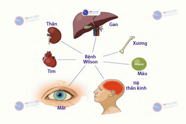 Biến chứng của bệnh Wilson