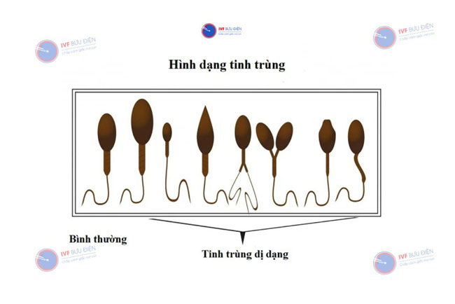 Tinh trùng dị dạng là gì
