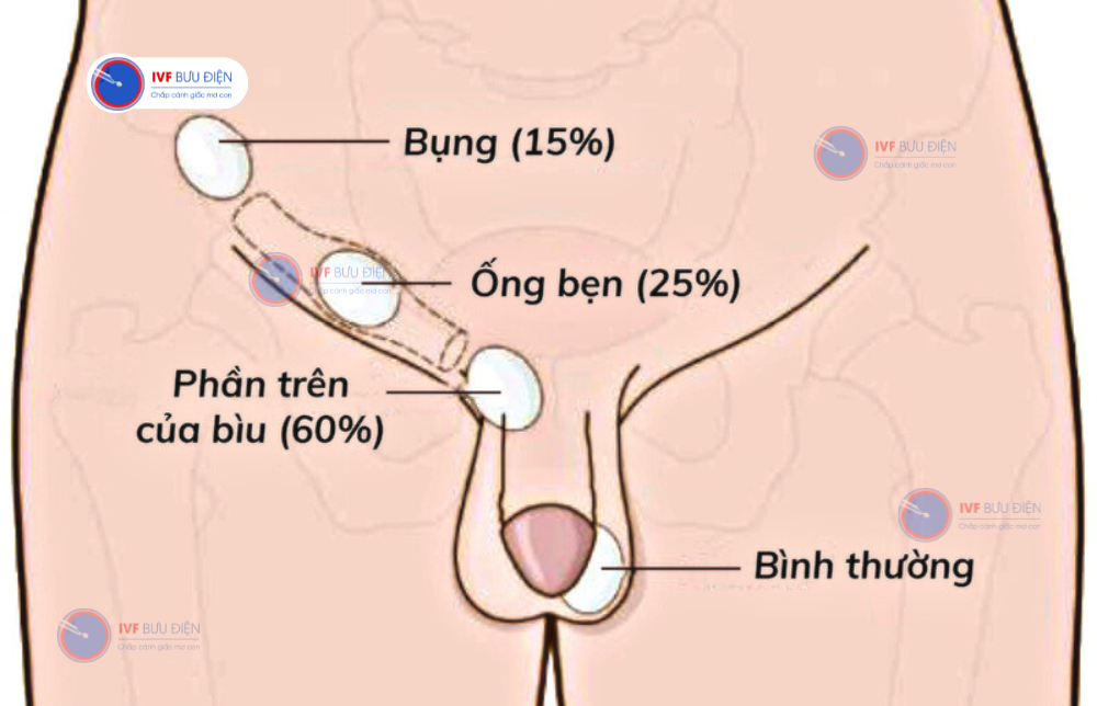 tinh hoàn lạc chỗ