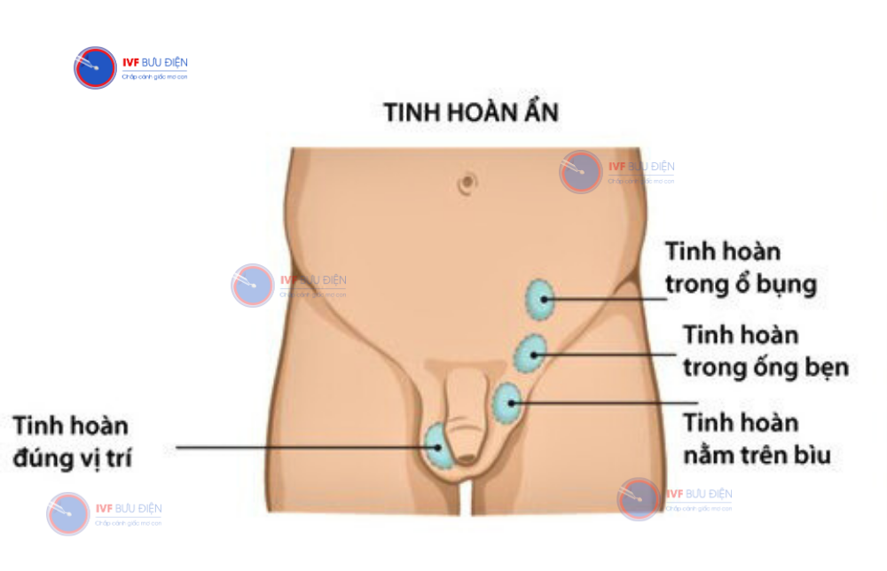 tinh hoàn ẩn