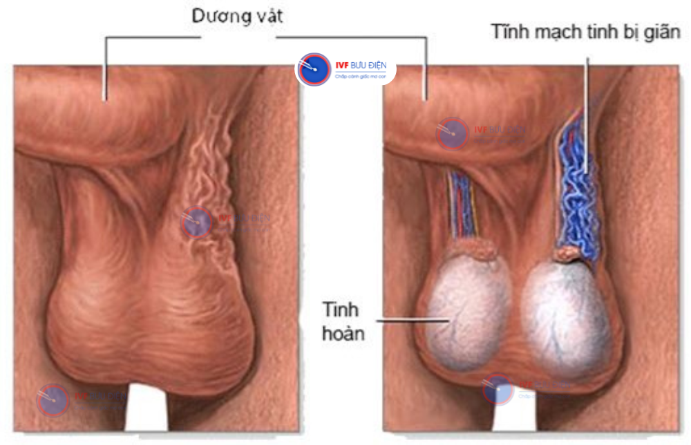 giãn tĩnh mạch thừng tinh