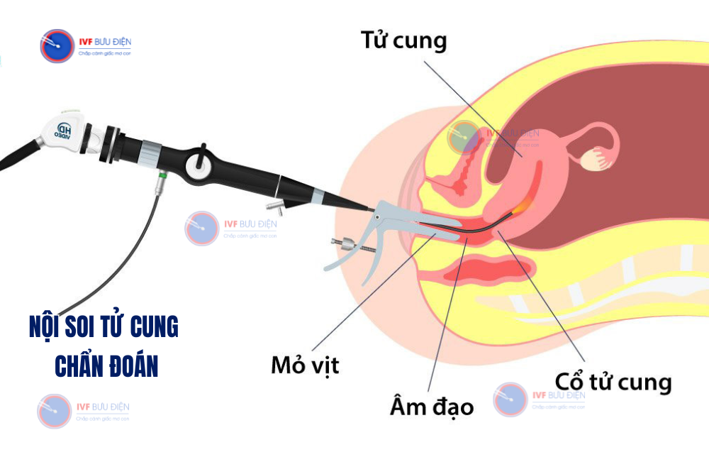 nội soi buồng tử cung chẩn đoán